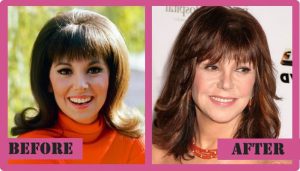 Marlo Thomas Plastic Surgery - Did She Have It?