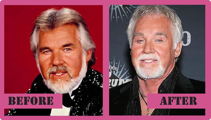 Kenny Rogers decided to have a facelift
