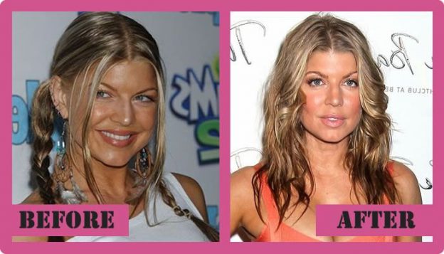 Fergie Plastic Surgery Makes Her Sexy
