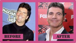 Simon Cowell Plastic Surgery - Speculations